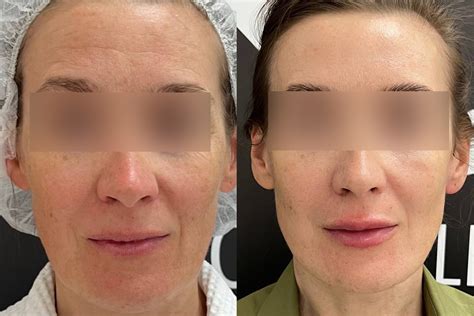 Ботулинотерапия лица в косметологии VIP Clinic в Москве. Цены на ...