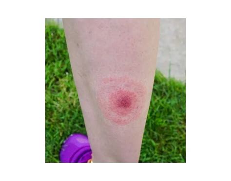 Malattia di Lyme: da dove viene, quali sono i sintomi e come si cura?