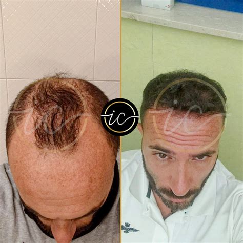 hair transplant clinics turkey 13