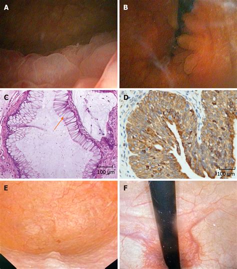 Cystoscopy and pathological results. A and B: Bladder lesions in the ...