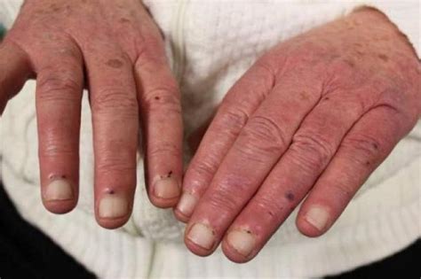 bacterial endocarditis oslers nodes  janeways lesions