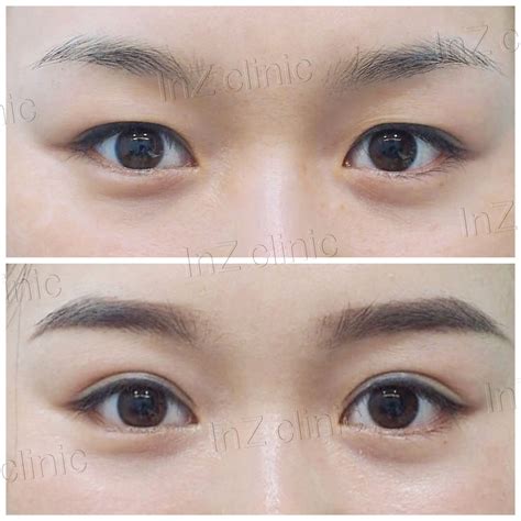 Current methods of double eyelid surgery, pros & cons - inZ Clinic