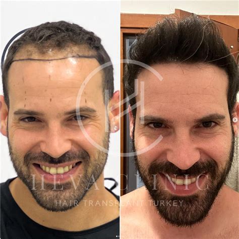 hair transplant    results berysv