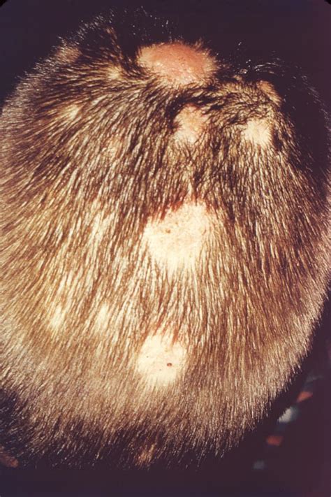 tinea barbae  scalp