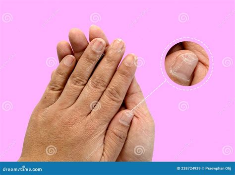 Dry And Cracked Fingernails