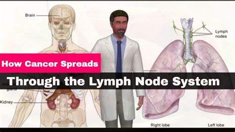 How Cancer Spreads Through The Lymph Node System - Male Health Clinic