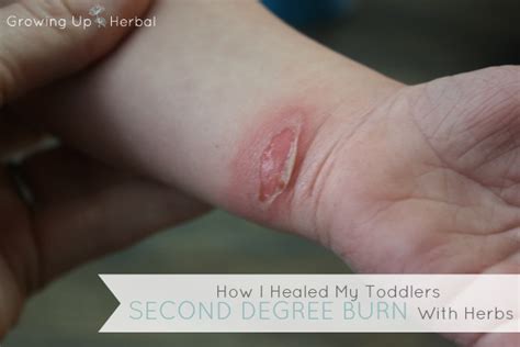 How I Healed My Toddler’s Second-Degree Burn With Herbs In Less Than 5 Minutes A Day - Growing ...