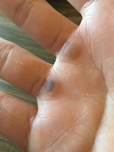 callus is looking like this anyone have this problem? what am i doing
