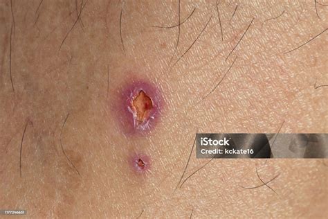 Feridinhas No Corpo O Que Pode Ser - Foto de Infecção Da Ferida Na Pele Uma Ferida No Corpo Humano Sutura ...
