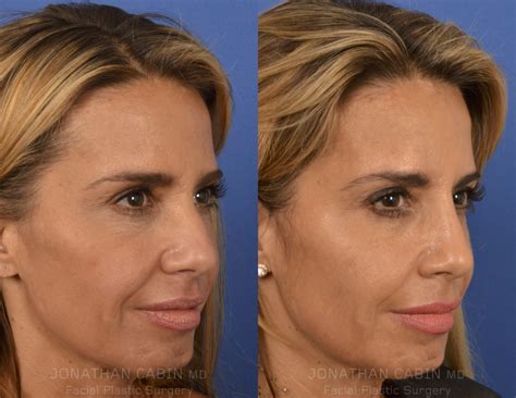 surgical rhinoplasty cabinmd facial plastics aesthetics