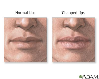 chapped lips uf health