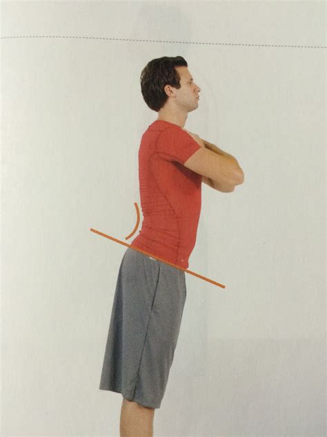 Lower Crossed Syndrome: A postural distortion syndrome characterized by