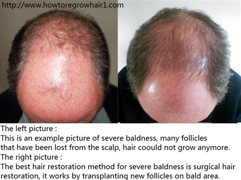 HAIR RESTORATION METHOD