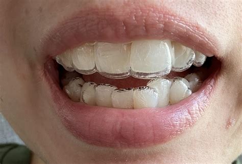 invisalign gap  tooth  aligner