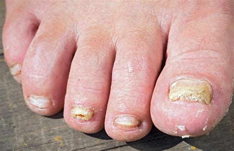 foot nail fungal infection reason  ruby vannatter blog