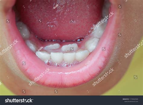 closeup double row teeth stock photo  shutterstock