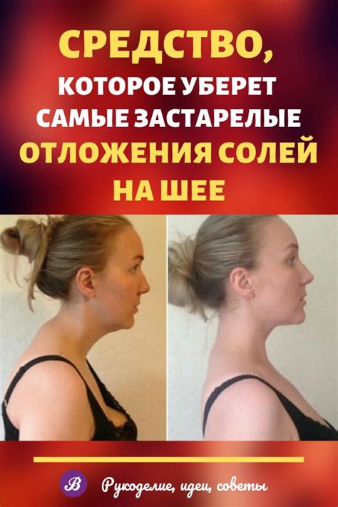 Отложение солей на шее называют остеохондрозом шейного отдела ...
