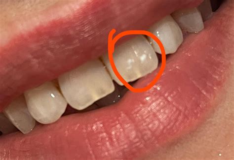 White spots after whitening : r/Teethcare