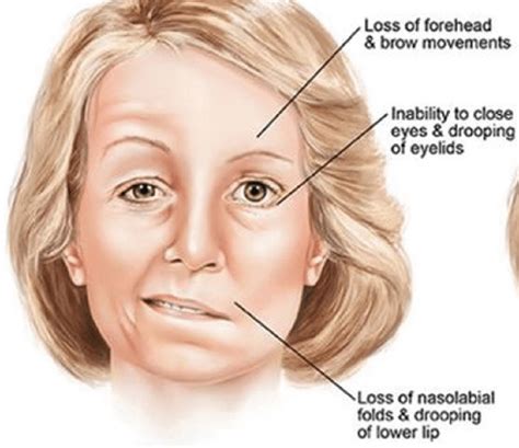 cranial nerve bells palsy
