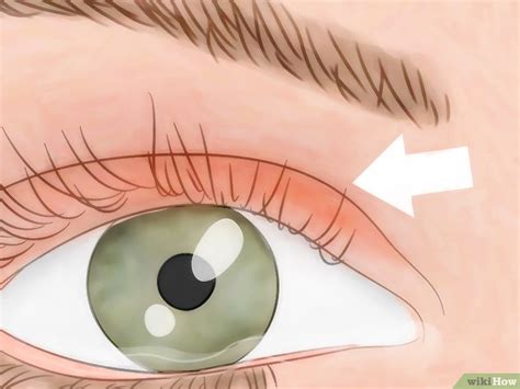 how to know if you have eye mites