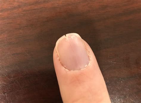 My nail grows out split down the middle : mildlyinteresting