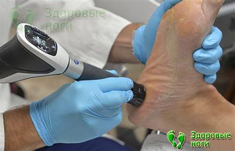 Подробно о лечении пяточной шпоры ультразвуком с гидрокортизоном ...