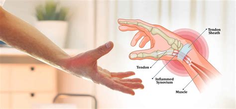 De Quervain’s Support in Malaysia | Thumb & Wrist Care