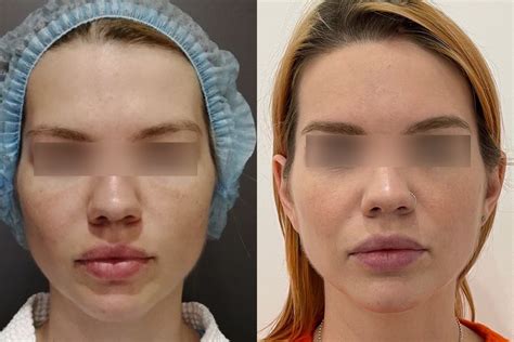 Нитевой лифтинг лица в Москве — VIP Clinic. Подтяжка лица без операции ...