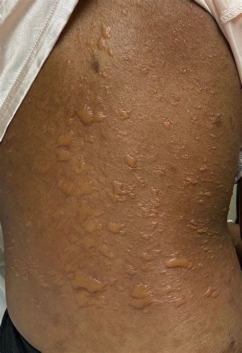 Bullous Systemic Lupus Erythematosus With Lupus Nephritis - Mayo Clinic ...