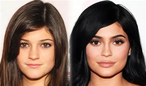 Kylie Jenner Before and After Plastic Surgery - Mayclinik