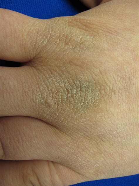Acanthosis nigricans - Dermatology Advisor