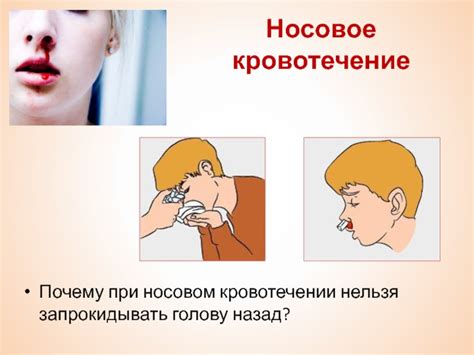 Сильное кровотечение из носа как остановить: Остановка носового ...