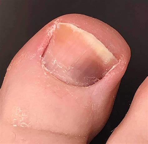 dark line through toenail 8