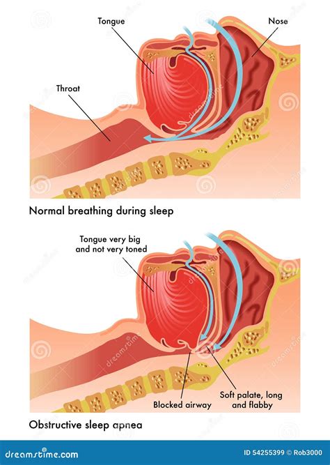 Sleep Apnea Diagram Labeled