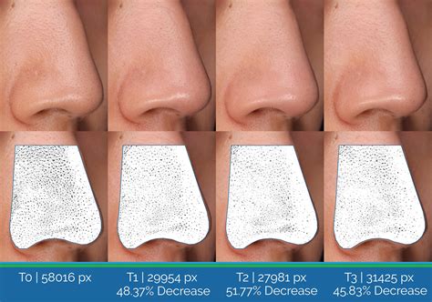 Transverse Nasal Crease 3
