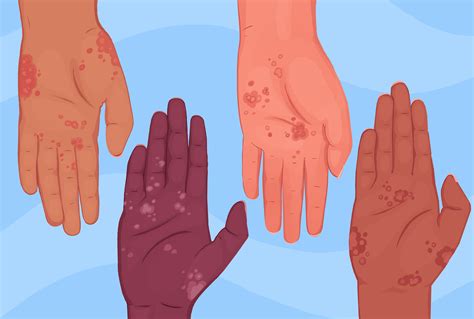 Psoriasis on Dark Skin: Appearance, Diagnosis, Management