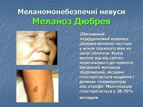 Злоякісні пухлини шкіри - презентация онлайн