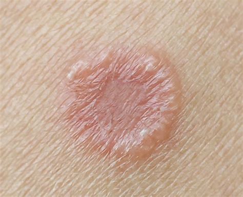 Ringworm Between Fingers