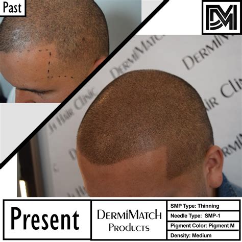 Things to Know About PRP Treatment for Hair Growth - DermiMatch Hair