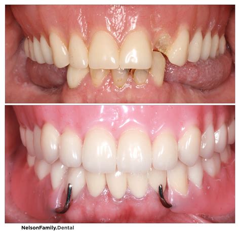 Before and After — Denture.Doctor | Redding, Ca