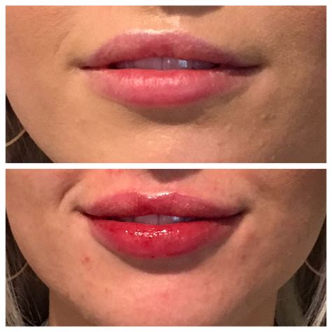 What Can You Put On Lips After Filler | Lipstutorial.org