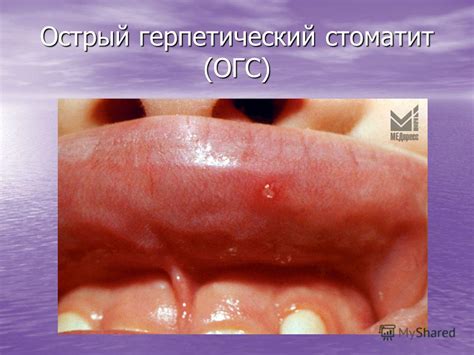 Презентация на тему: "Стоматиты у детей.. Слизистая оболочка ротовой ...