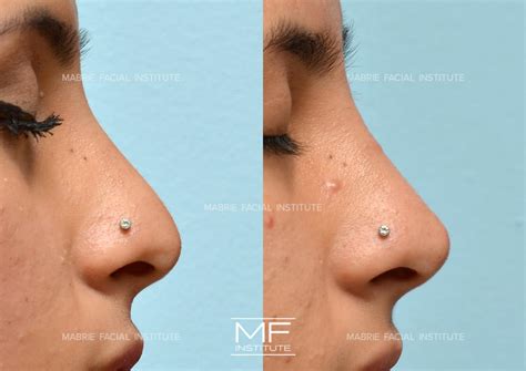 4 Ways To Make Your Nose Appear Smaller With Filler | Mabrie Facial
