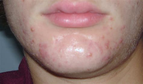 ziana log - Personal logs - Acne.org