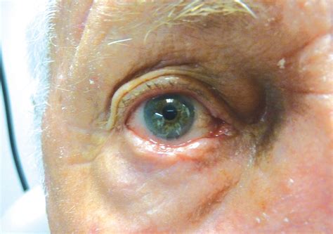 Eyelid Lumps and Bumps - Desert Doctors