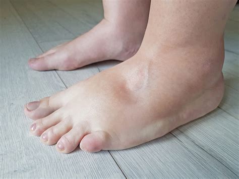 Edema: Types, Causes, Signs & Treatment Options