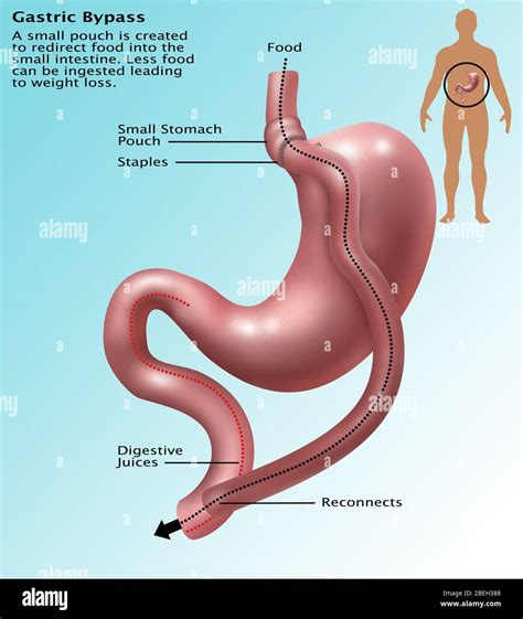 gastric bypass surgery stock photo alamy