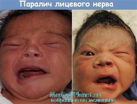Причины лицевого паралича у детей