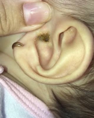 Secreção No Ouvido Do Bebe - Cera no ouvido do bebê | BabyCenter