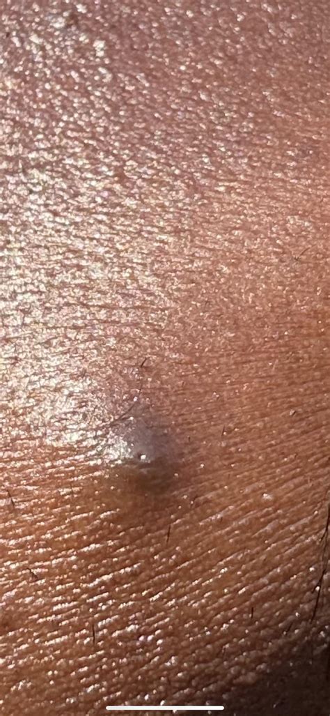 A pimple that never goes away : r/AcneTreatments